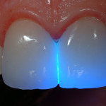 Trattamento con tecnologia Laser