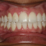 Risultato finale con utilizzo della mascherina Invisalign