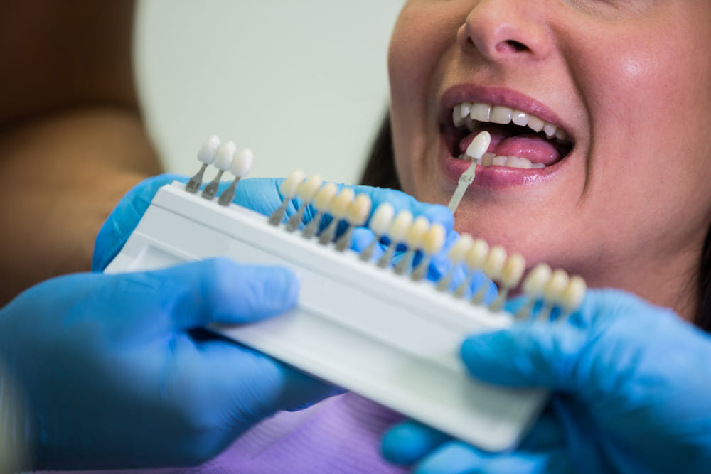costi corona dentale