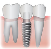 impianti dentali