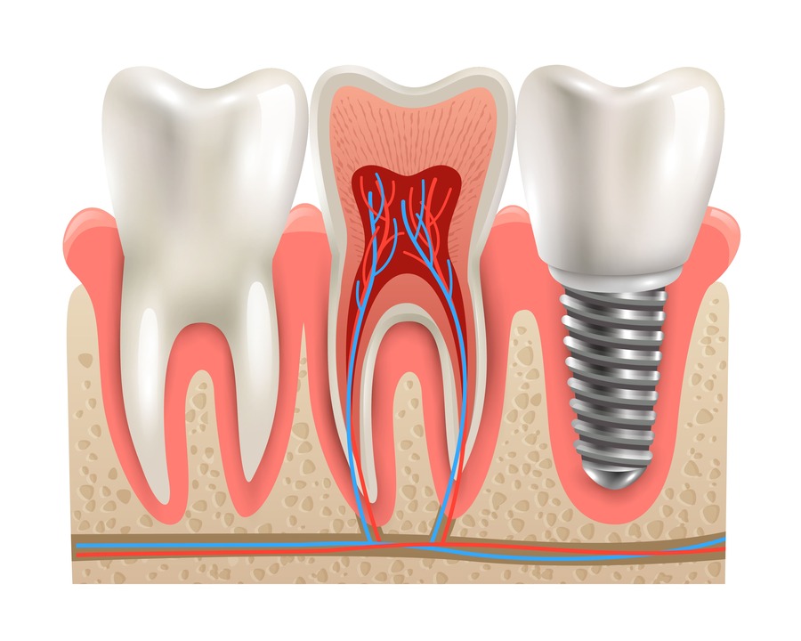 impianti dentali materiali migliori