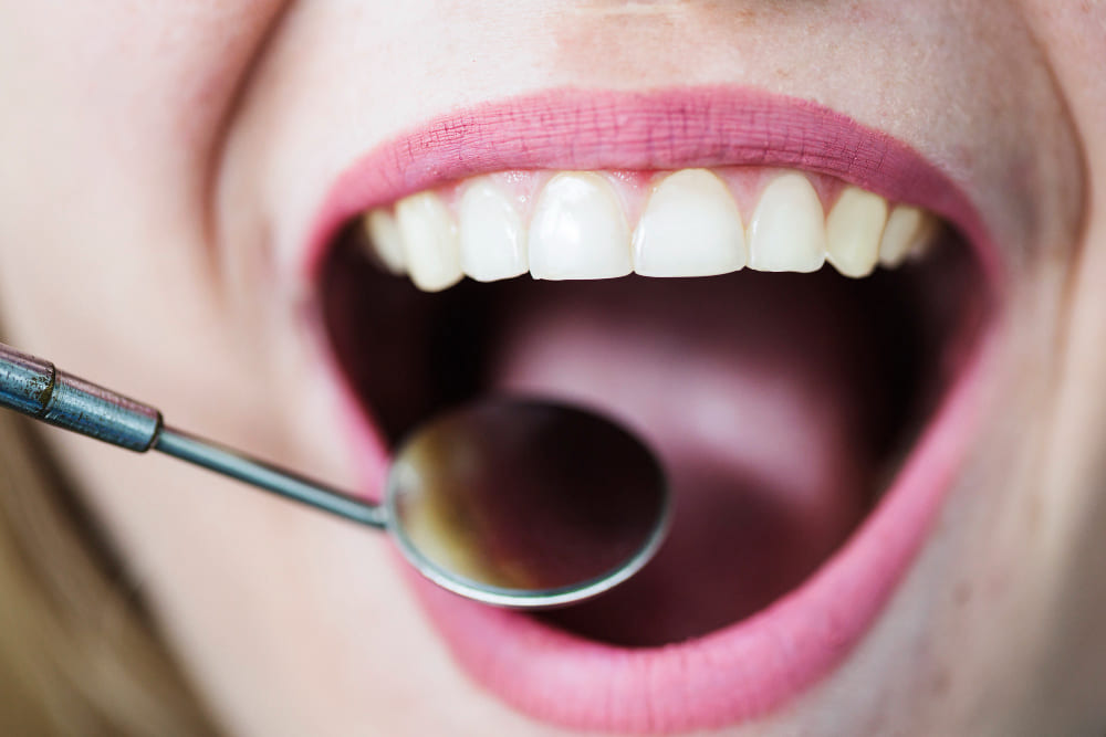 impianto dentale arcata superiore