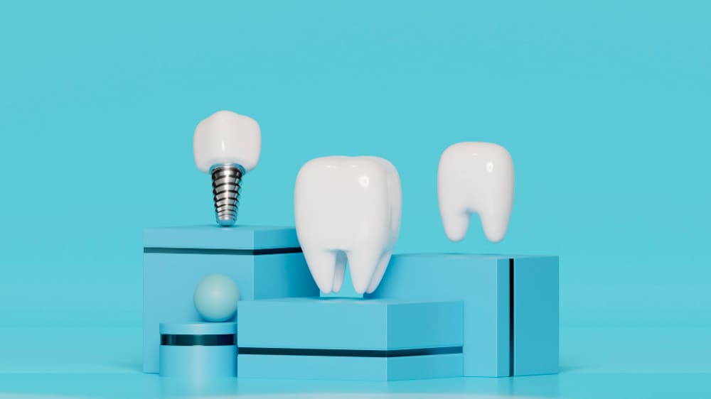 impianto dentale con ponte