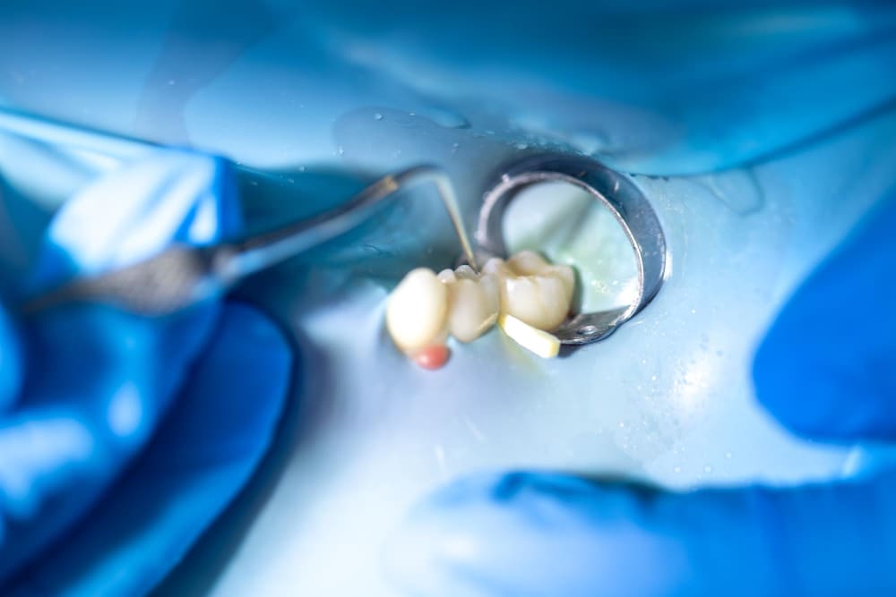 implantologia dentale prezzi