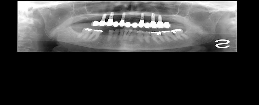 protesi zirconia cad cam